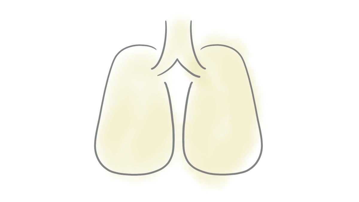 2.9.1.4 Gewöhnliche Bronchitis und Husten