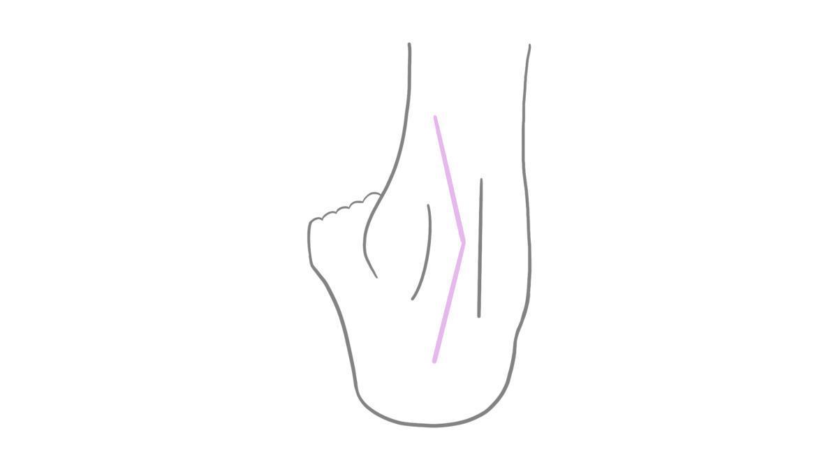 8.4.1 Fußfehlstellungen 8.4.1 Fußfehlstellungen