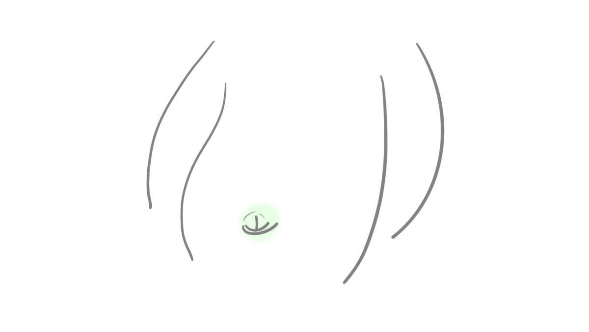8.6.2 Nabelhernie