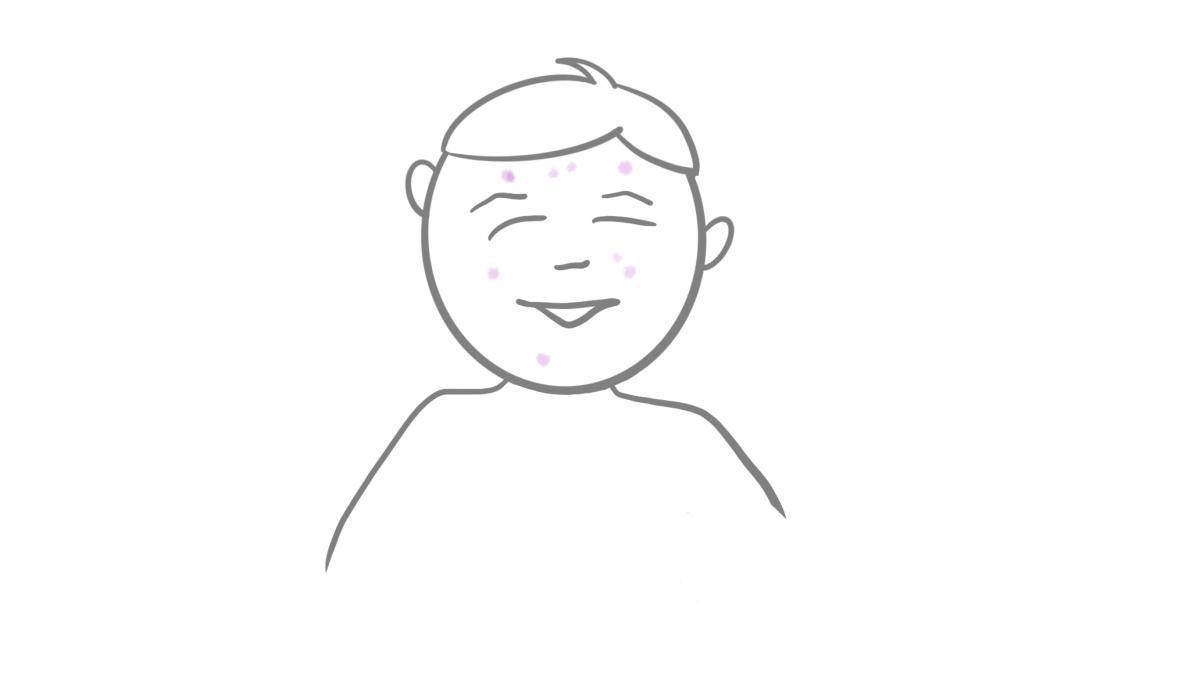 8.2.2 Akne 8.2.2 Akne