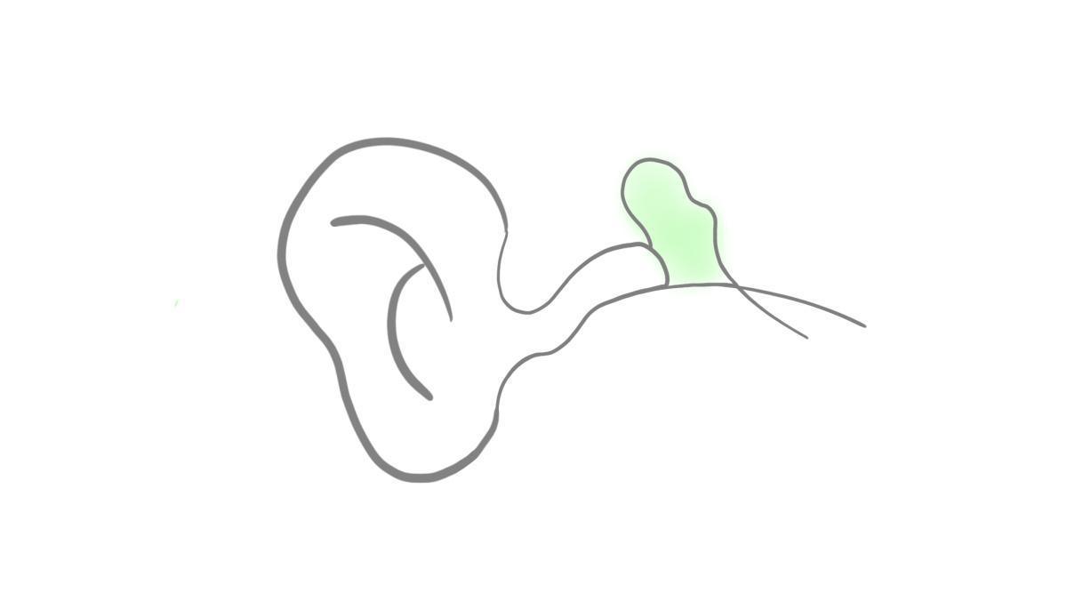 8.3.3 Paukenerguss 8.3.3 Paukenerguss