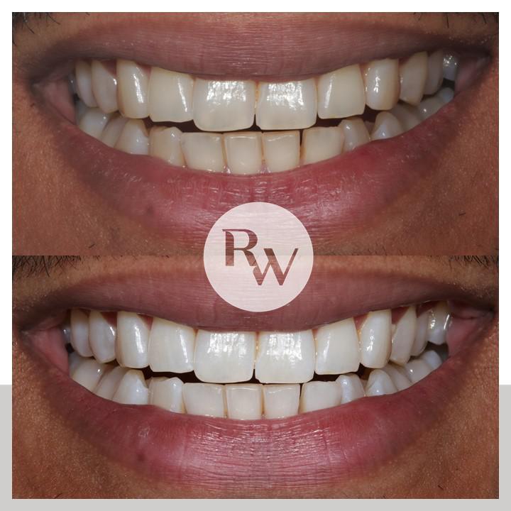 The RW Perio Polish & Perfect