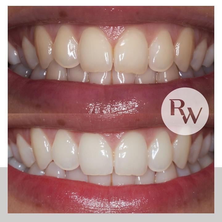 The RW Perio Advanced Maintenance