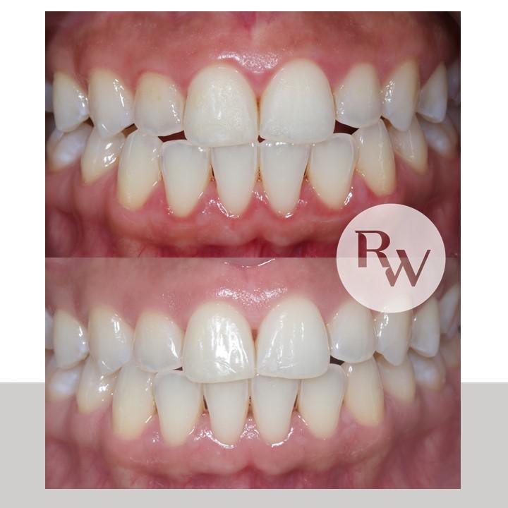 The RW Perio Restorative