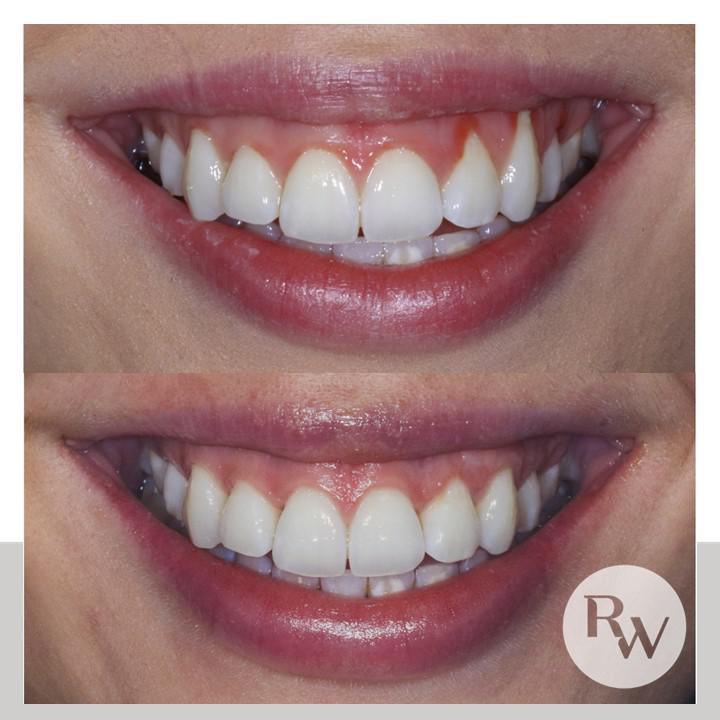 The RW Perio Preventive