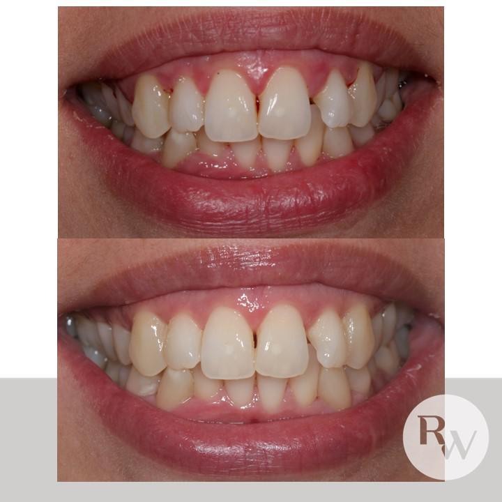 The RW Perio Focused