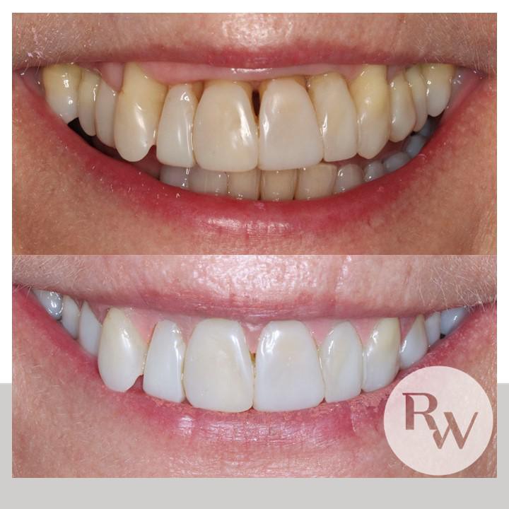 The RW Perio Gum Veneer