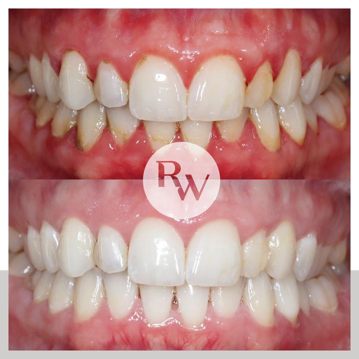 The RW Perio Complete