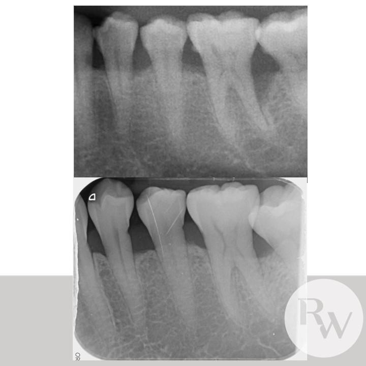 The RW Perio Regenerative