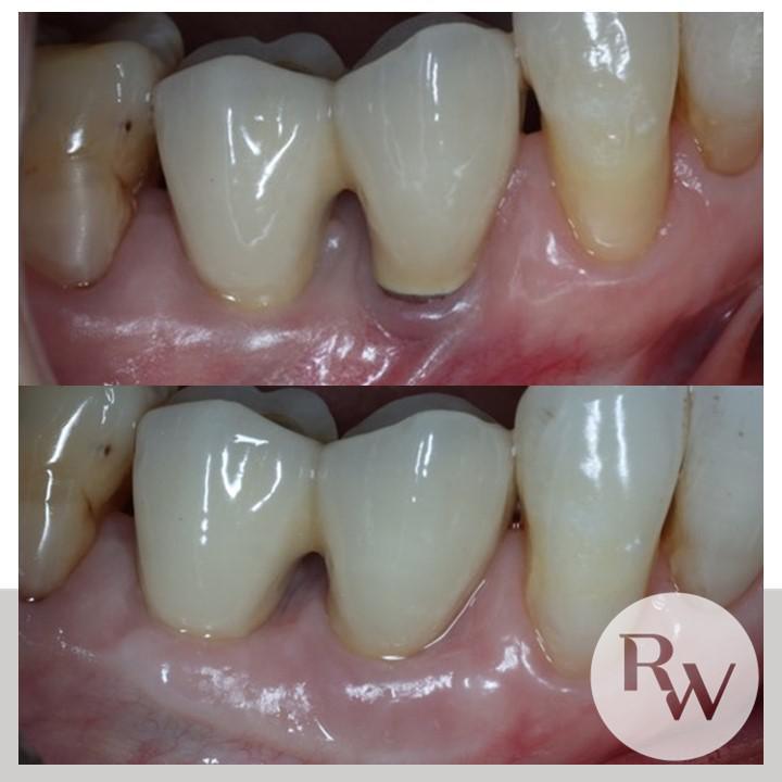 The RW Perio Implant Recovery