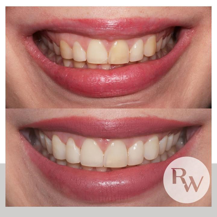 The RW Perio Restorative