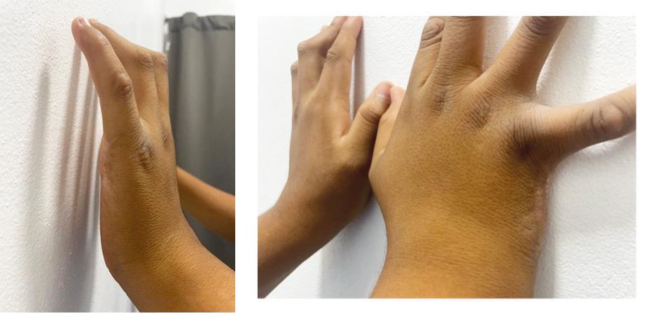 Cuando las matemáticas fallan. Síndrome de Bardet-Biedl: una expresión familiar más allá del 25% Cuando las matemáticas fallan. Síndrome de Bardet-Biedl: una expresión familiar más allá del 25%