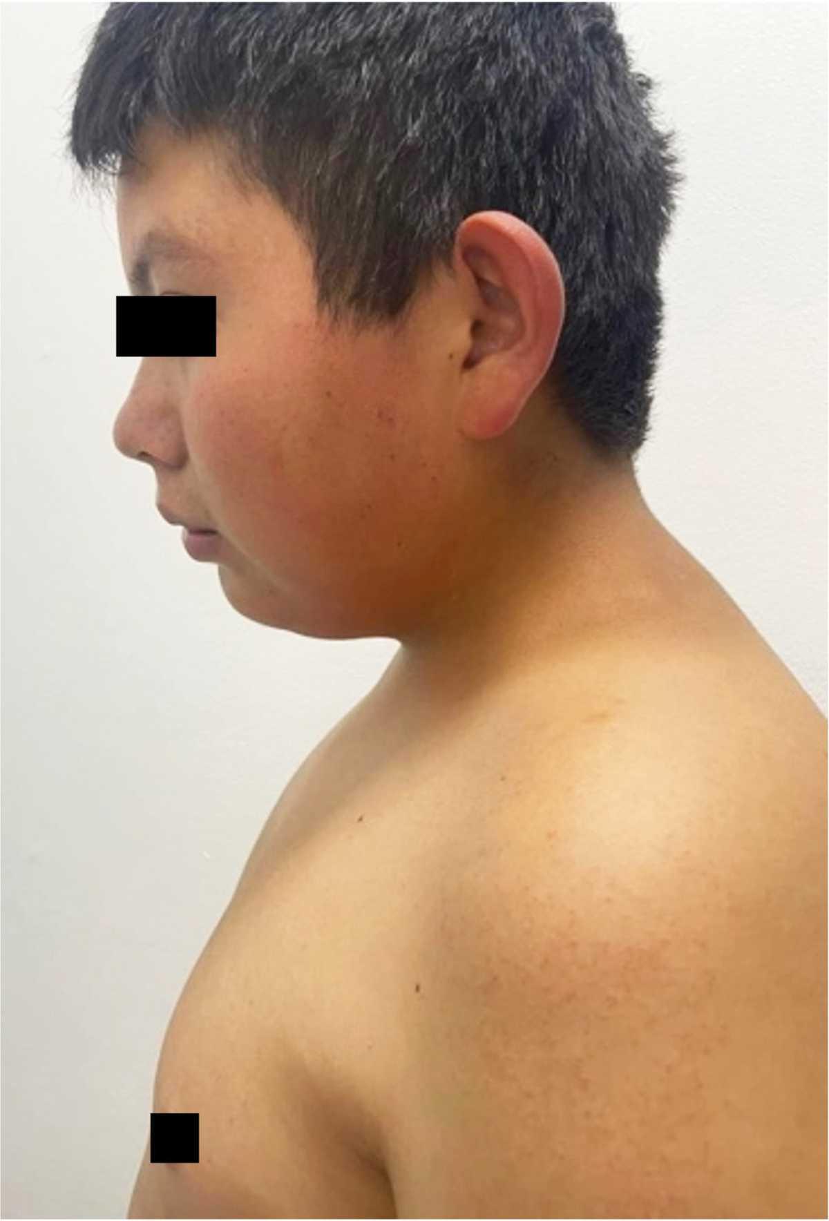 Cuando las matemáticas fallan. Síndrome de Bardet-Biedl: una expresión familiar más allá del 25% Cuando las matemáticas fallan. Síndrome de Bardet-Biedl: una expresión familiar más allá del 25%