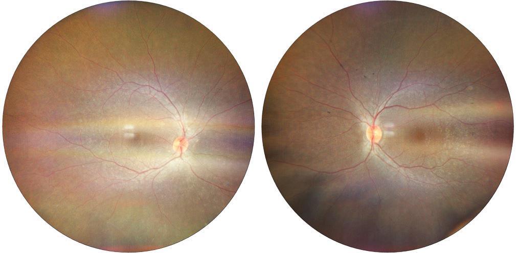Cuando las matemáticas fallan. Síndrome de Bardet-Biedl: una expresión familiar más allá del 25% Cuando las matemáticas fallan. Síndrome de Bardet-Biedl: una expresión familiar más allá del 25%