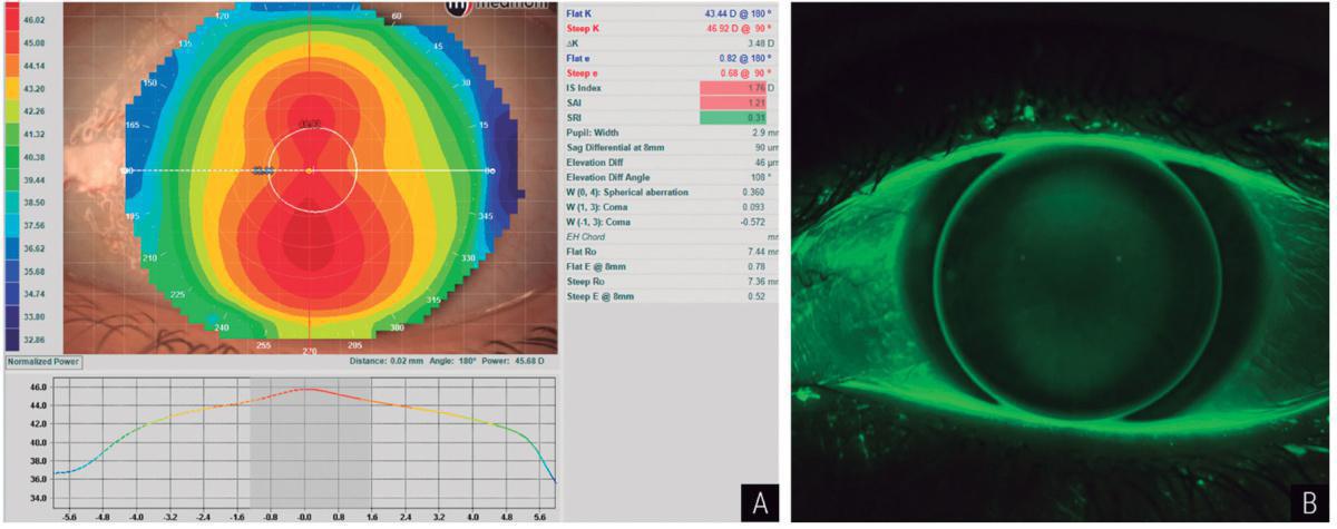 Adaptación empírica de lentes GP (Primera parte) Adaptación empírica de lentes GP (Primera parte)
