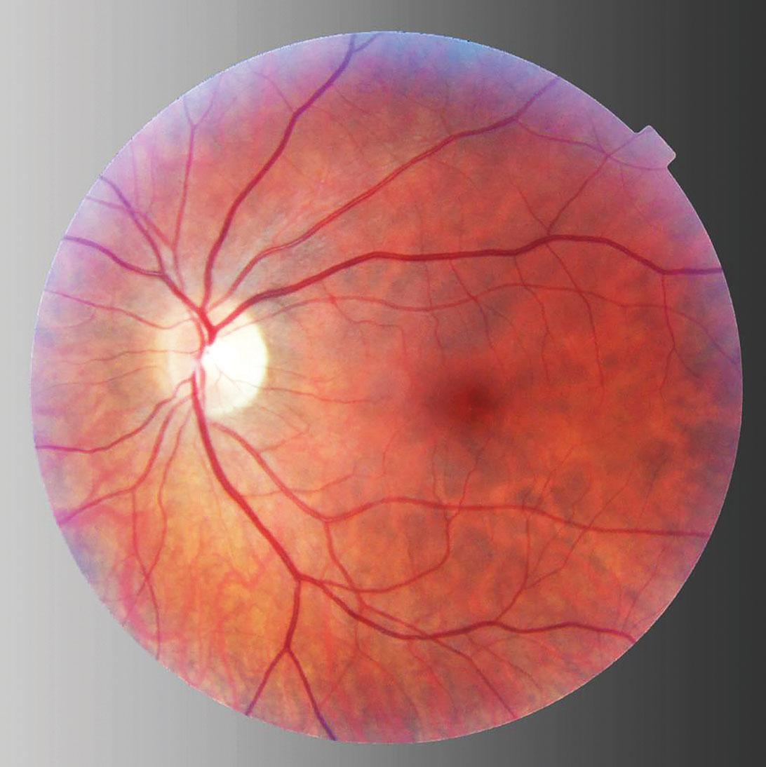 Revisión sobre la reparación del desprendimiento de retina Revisión sobre la reparación del desprendimiento de retina