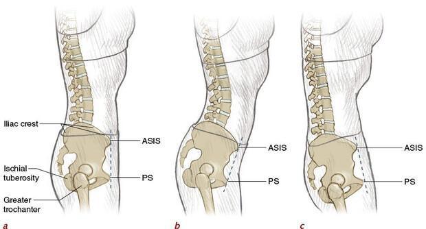 Training Blog: What is neutral pelvis? Training Blog: What is neutral pelvis?