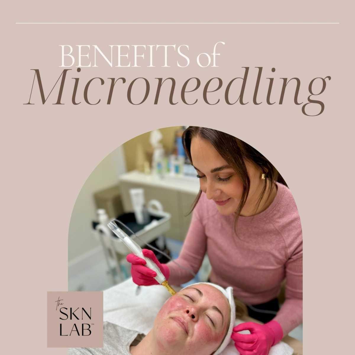 Benefits of Microneedling 