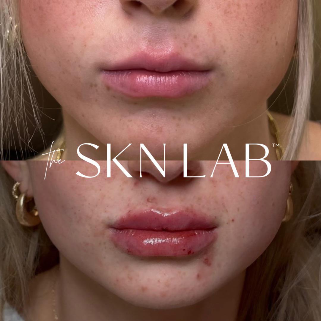 M-shaped Lip Correction