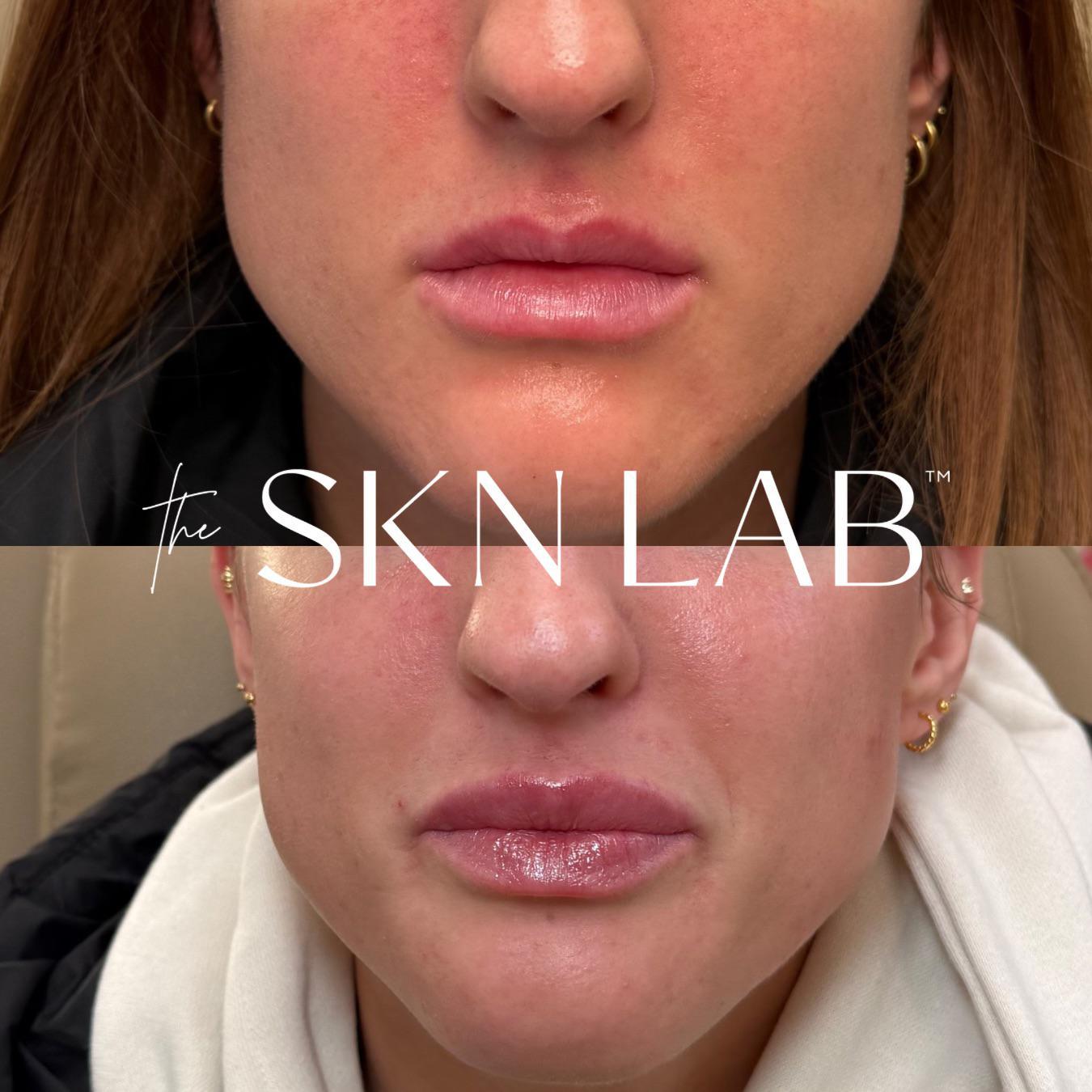 M shape Lip correction