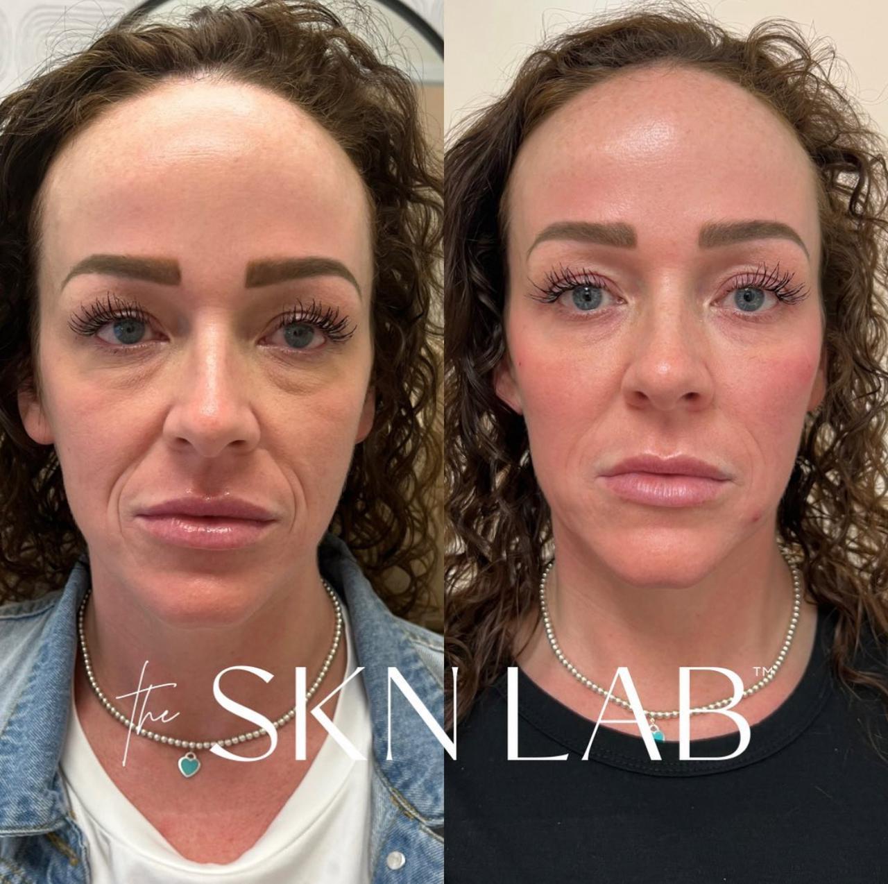 Full Face Rejuvenation