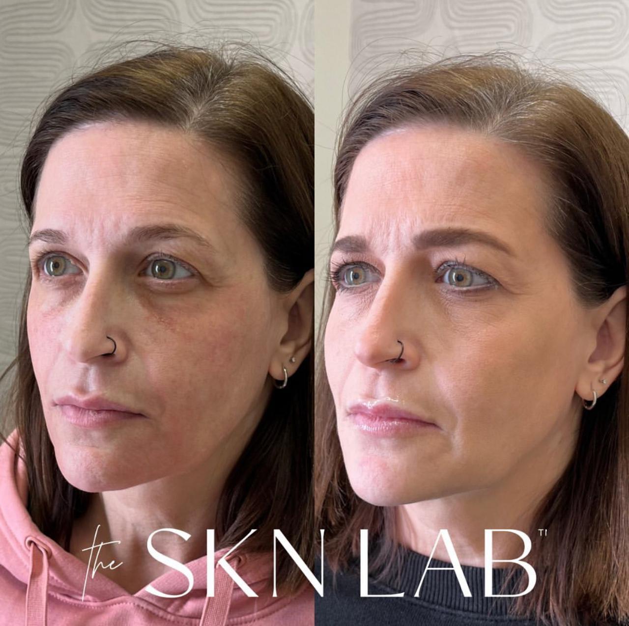 Full Face Rejuvenation