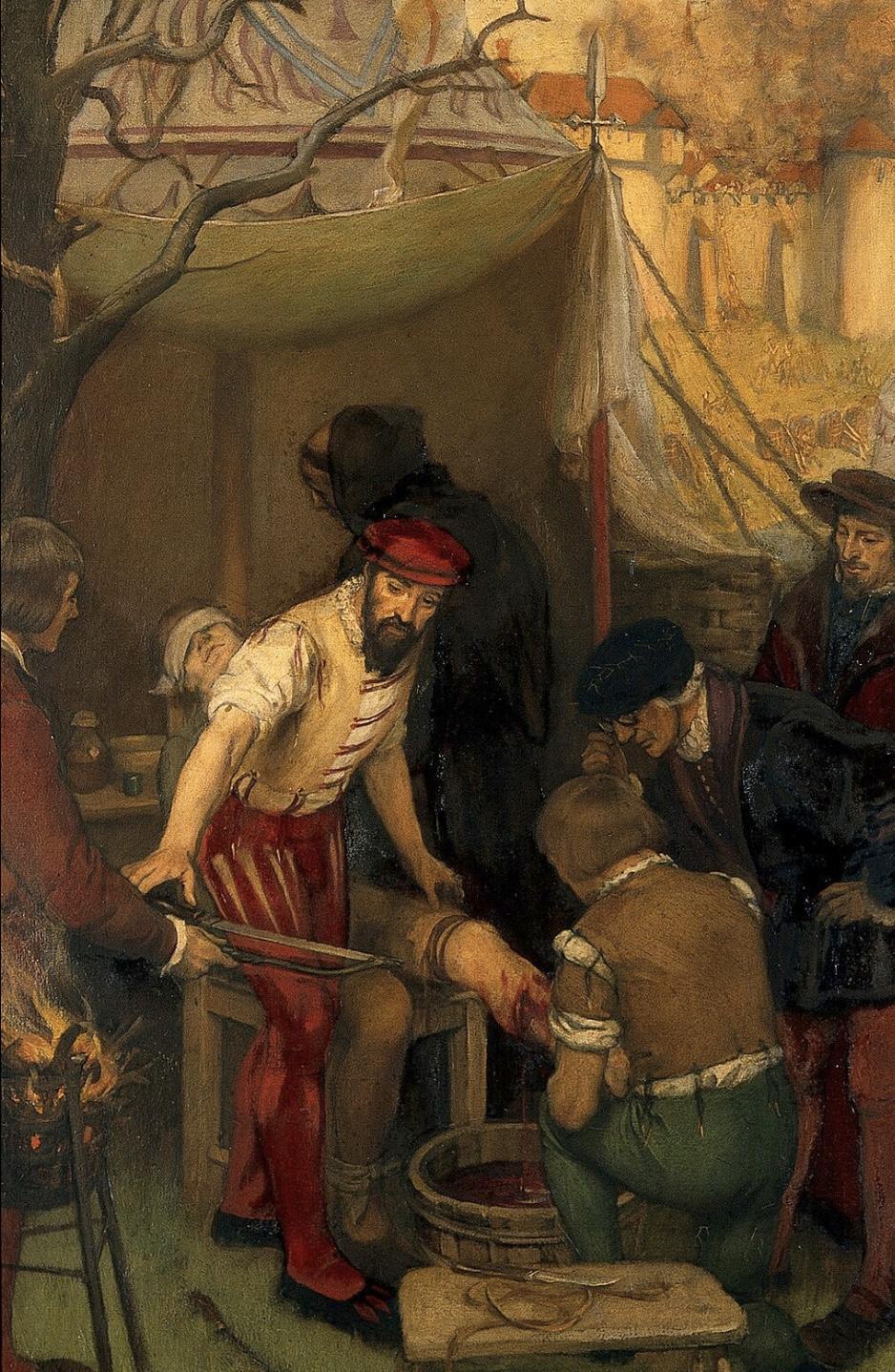 Ambroise Paré : Pionnier de la chirurgie moderne