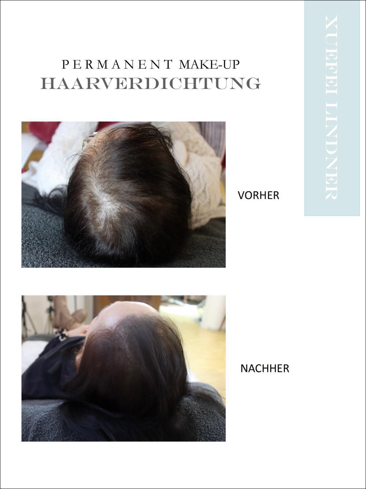 Haaransatzverdichtung