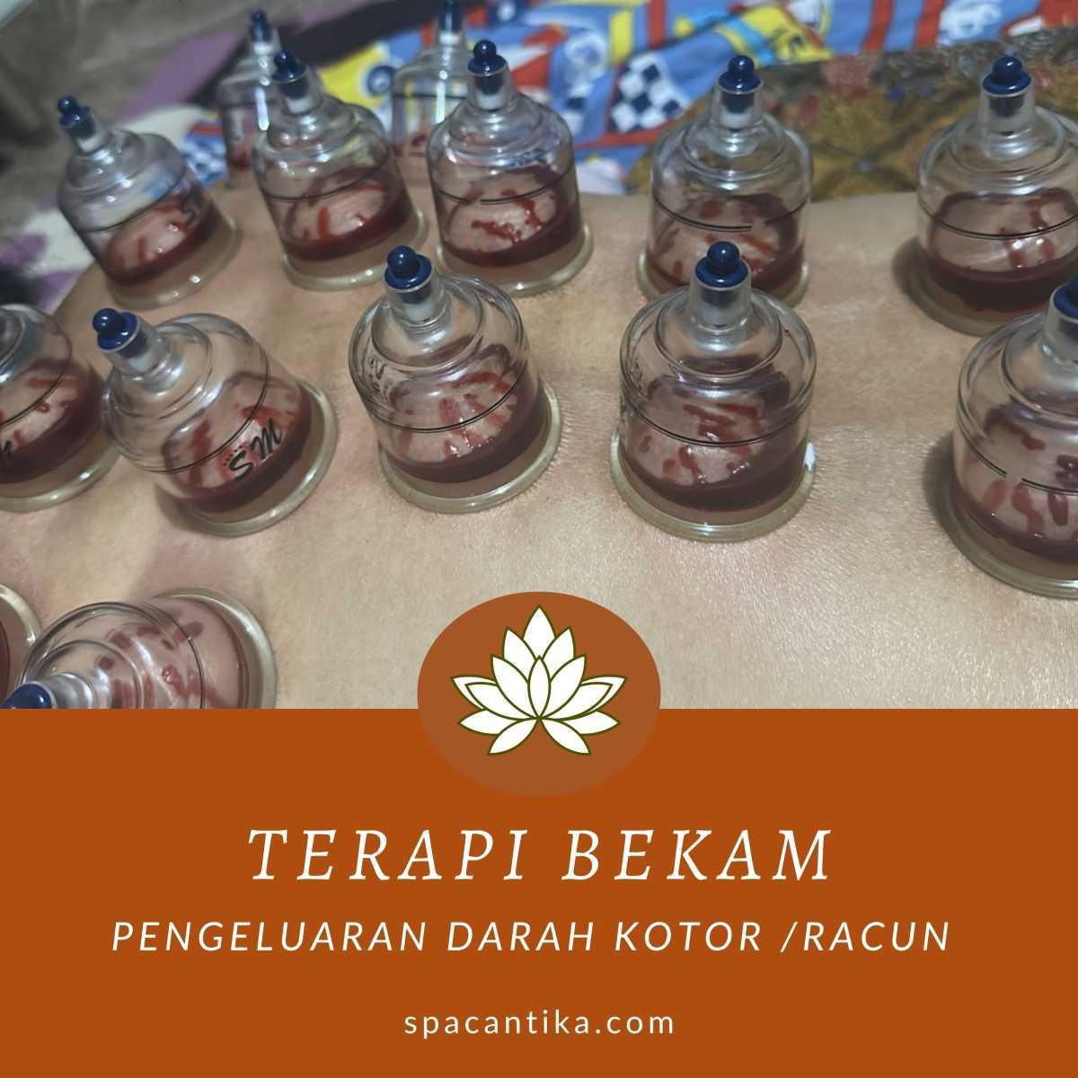Terapi Bekam Terapi Bekam