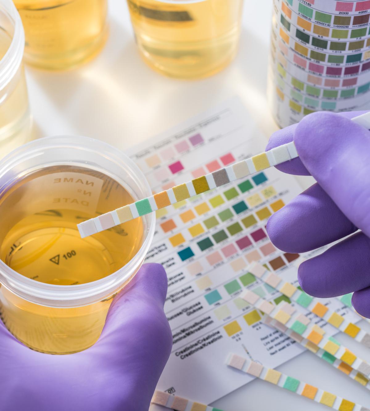 Esame delle urine Esame delle urine