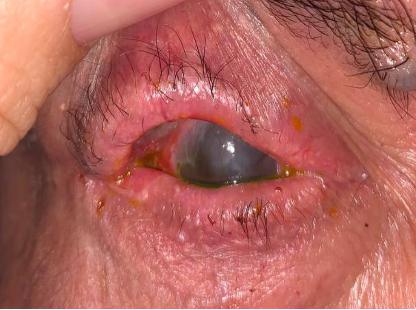 Conjuntivitis Cicatricial, Diagnóstico por Inmunofluorescencia Reporte de Caso