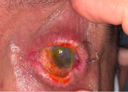 Conjuntivitis Cicatricial, Diagnóstico por Inmunofluorescencia Reporte de Caso