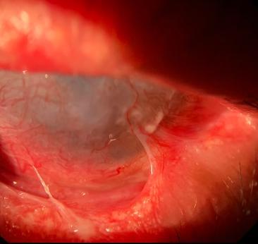 Conjuntivitis Cicatricial, Diagnóstico por Inmunofluorescencia Reporte de Caso