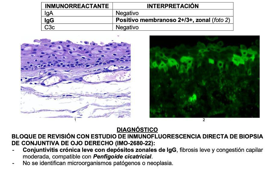 Conjuntivitis Cicatricial, Diagnóstico por Inmunofluorescencia Reporte de Caso