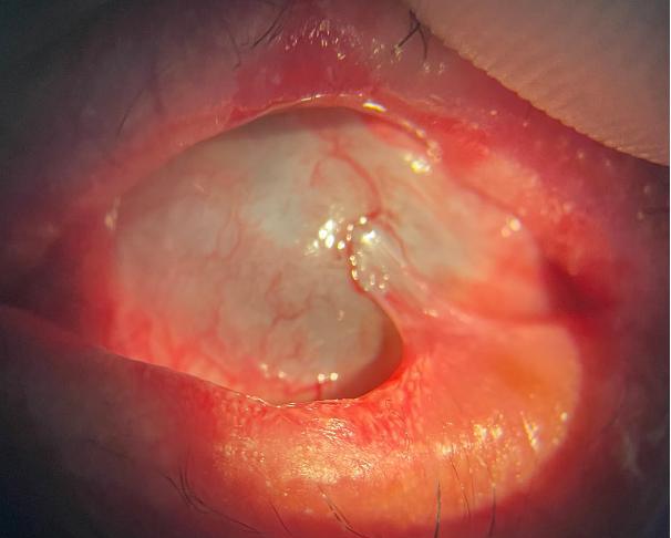 Conjuntivitis Cicatricial, Diagnóstico por Inmunofluorescencia Reporte de Caso