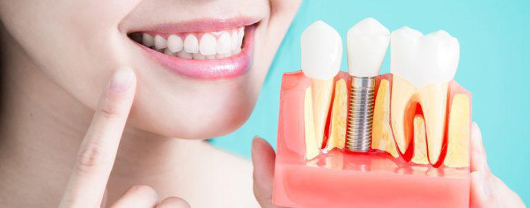 DENTAL IMPLANT