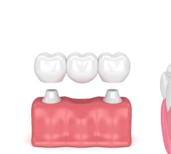 PROSTHODONTICS DENTISTRY