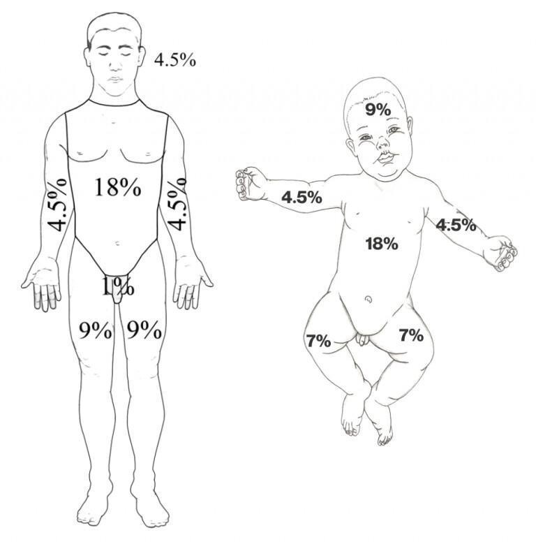 Burns and Inhalational Injury Burns and Inhalational Injury