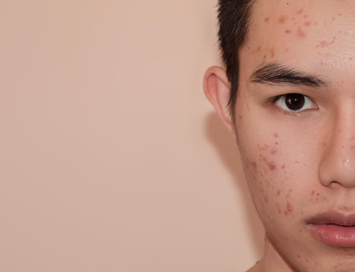 Your Acne Isn’t Just Hormonal—It’s Heat-Driven Your Acne Isn’t Just Hormonal—It’s Heat-Driven