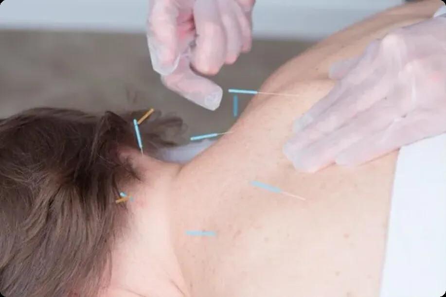 Dry Needling Dry Needling