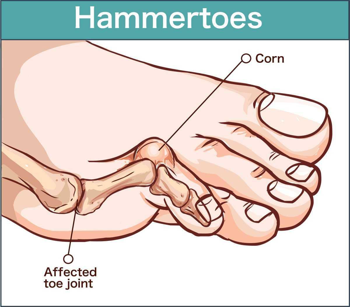 Hammer Toe Hammer Toe