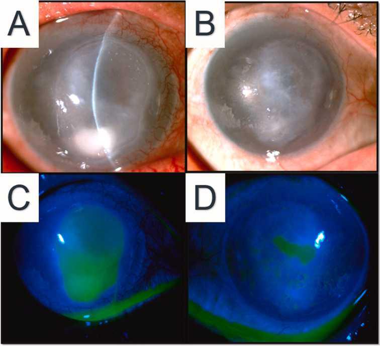 Queratopatía Neurotrófica: Una visión general y una visión al futuro