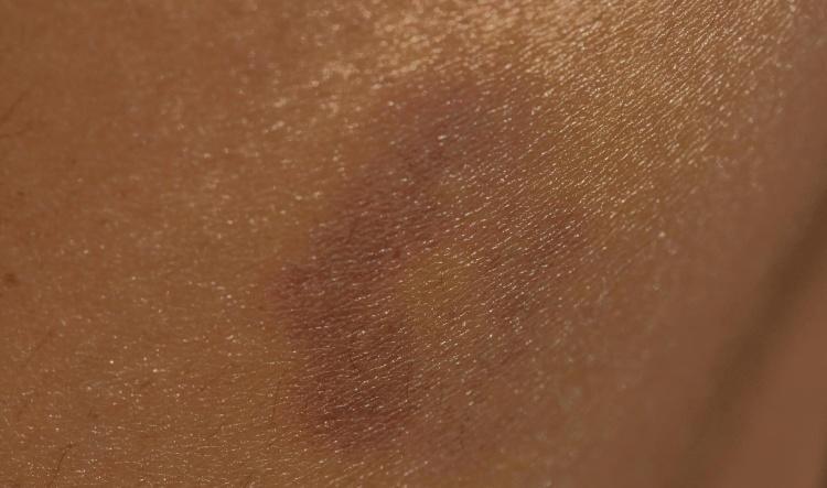 The suction is gonna leave a mark! That's gotta suck...