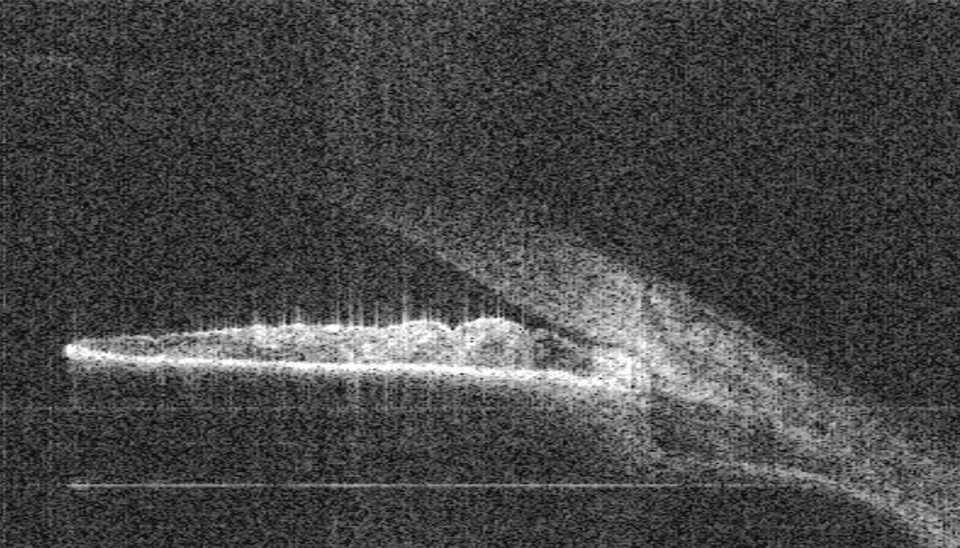 Manejo del iris en meseta y del cierre angular Manejo del iris en meseta y del cierre angular