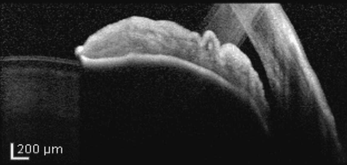 Manejo del iris en meseta y del cierre angular Manejo del iris en meseta y del cierre angular