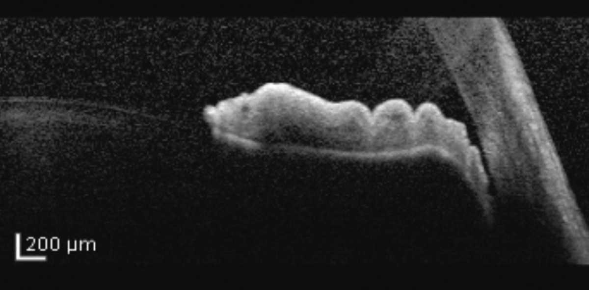 Manejo del iris en meseta y del cierre angular Manejo del iris en meseta y del cierre angular