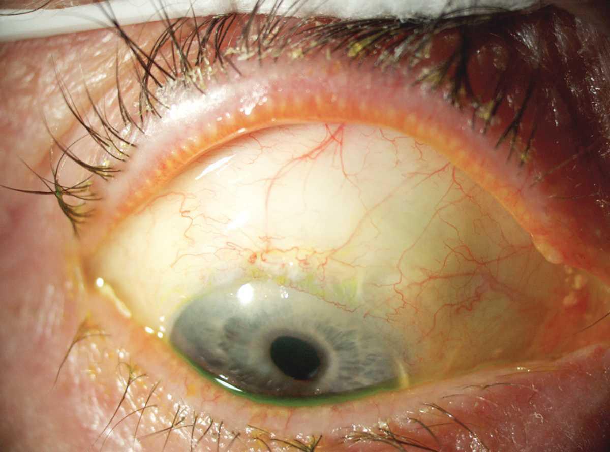 Prevención y manejo de complicaciones de la trabeculectomía Prevención y manejo de complicaciones de la trabeculectomía