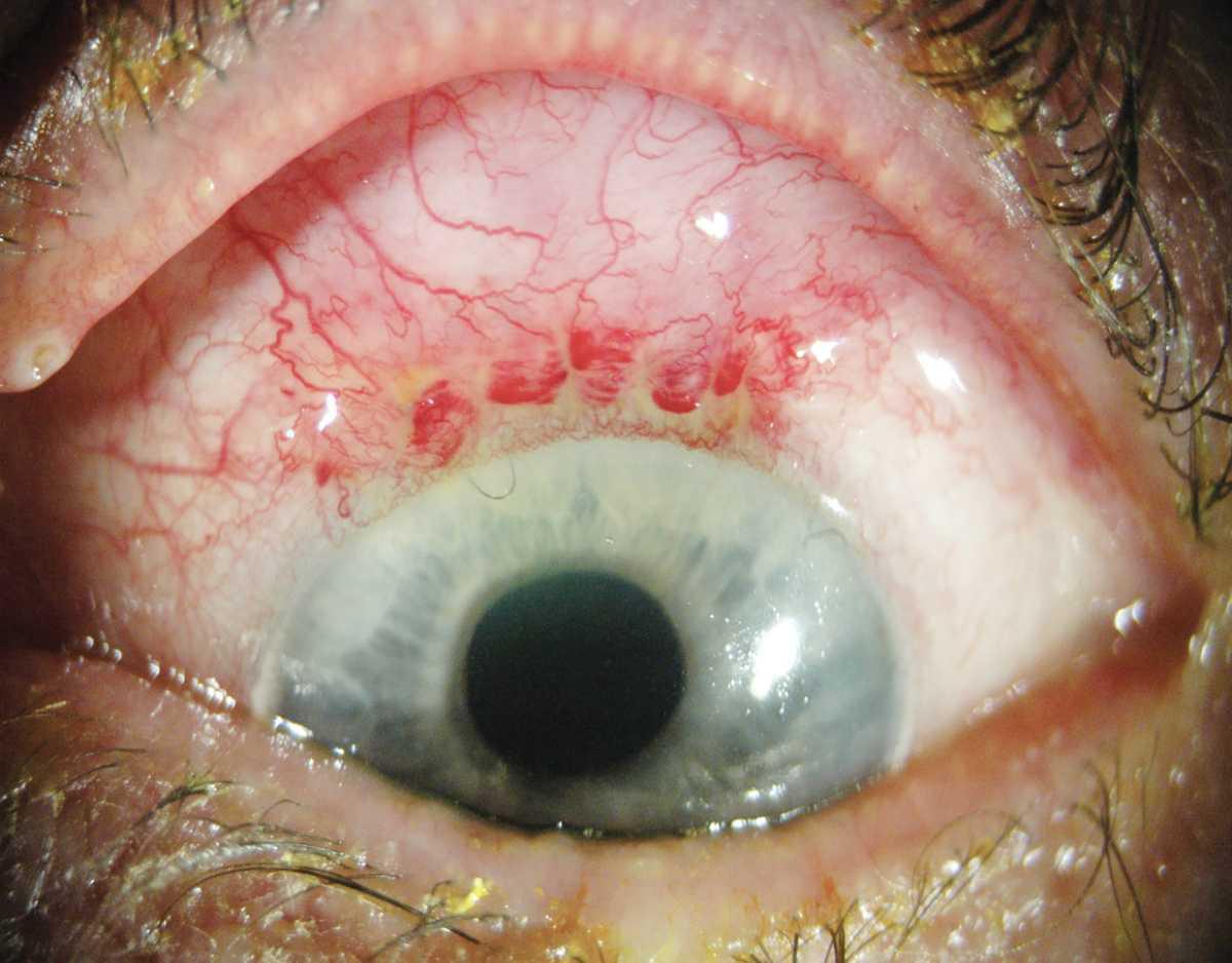 Prevención y manejo de complicaciones de la trabeculectomía Prevención y manejo de complicaciones de la trabeculectomía
