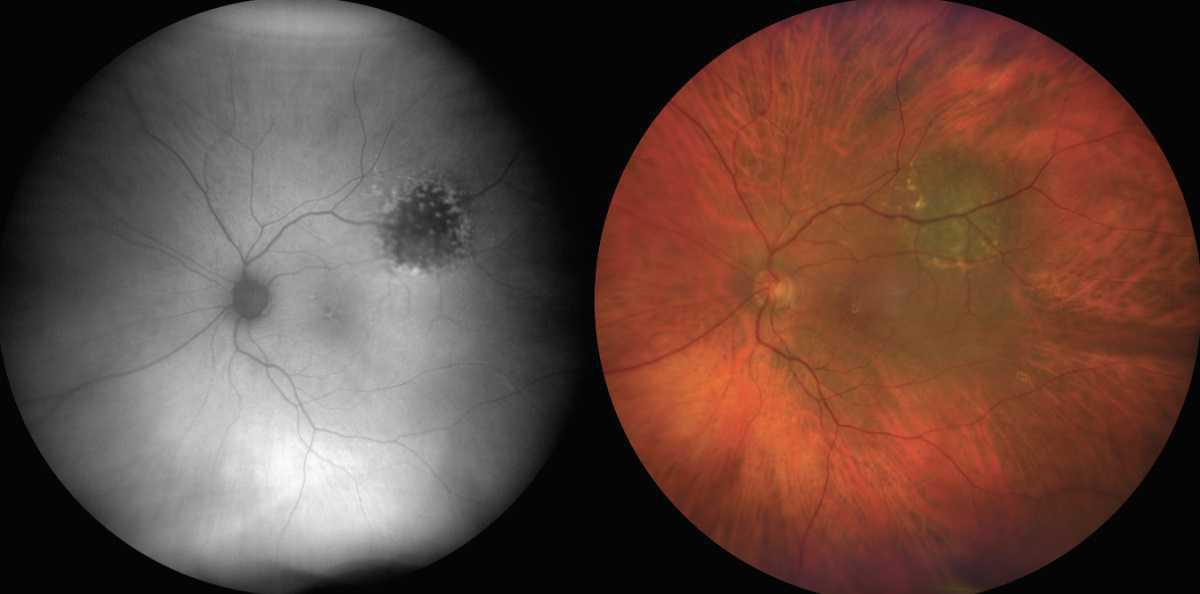 Tumores intraoculares y glaucoma
