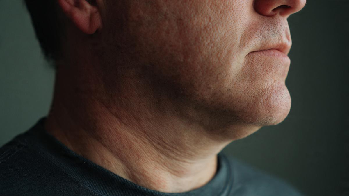 The Truth About Cortisol Face